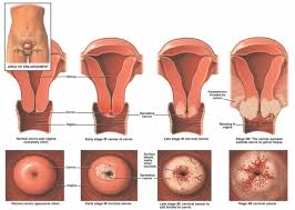 These include pelvic pain, abnormal bleeding, and urinary abnormalities. Cervical Cancer Physiopedia