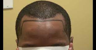 A receding hairline means your hair is starting to fall out from the front and around your temples. View How To Fix Receding Hairline Black Male In 2021 Fix Receding Hairline Prp Hair Treatment Hair Loss Men