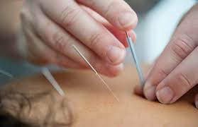 Image result for Acupuncture