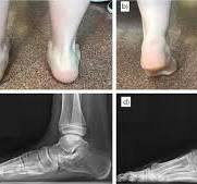 The role of arthroereisis of the subtalar joint for flatfoot ...