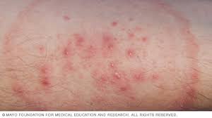 Tests for inner thigh rashes. Slide Show Common Skin Rashes Mayo Clinic