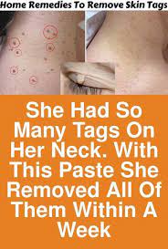 She Had So Many Tags On Her Neck With This Paste She Removed All Of Them Within A Week Today I Am Sharing Skin Tags Home Remedies Skin Tag Removal