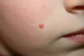 Retirer un grain de beauté. Supprimer Grains De Beaute A Geneve Centre Dermatologie Cornavin