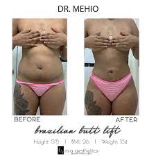 My loved one is now in icu after a faulty . Mia Aesthetics Snatched Bbl By Dr Mehio Facebook