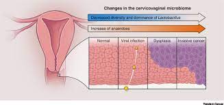 Did you know risk factors for stomach (gastric) cancer include a diet high in salty or smoked food or having an h. The Cancer Microbiome Distinguishing Direct And Indirect Effects Requires A Systemic View Trends In Cancer