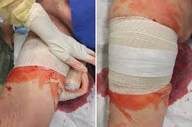 Nearly five times more mass than the 308. Wound Packing Essentials For Emts And Paramedics Jems