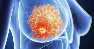 Cancer can start almost anywhere in the human body, which is made up of trillions of cells. Get The Facts About Breast Cancer Get Healthy Stay Healthy