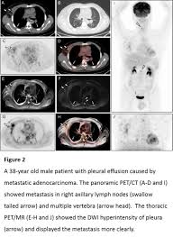 Mri adds value to further assess invasion of the tumor into the diaphragm, chest . Diagnostic Value Of 18f Fdg Panoramic Pet Ct Combined With Thoracic Pet Mri In Malignant Pleural Effusion Journal Of Nuclear Medicine
