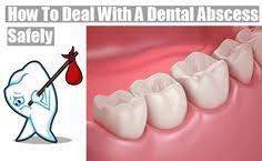 How To Treat Infected Tooth Home Remedies For Abscess Tooth How To Get Rid Of Tooth Infection Symptoms Causes Of Tooth Infection Abscess Tooth Teeth Remedies