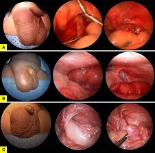 Image result for Inguinal hernia man