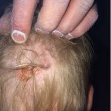 Image result for sores on the head in children