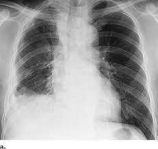 Check spelling or type a new query. Malignant Mesothelioma In A 51 Year Old Man A Chest Radiograph Shows Download Scientific Diagram