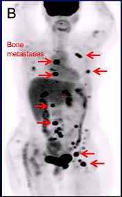 Abdominal ct scan is a diagnostic imaging technique that provides a clear picture of the state of internal what is an abdominal ct scan? Expert Opinion Imaging And Lobular Breast Cancer The Lobular Breast Cancer Alliance