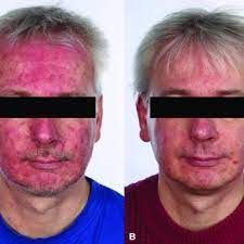 I have had rosacea for over 2 years. Rosacea Photographs Of A Female Subject In The Ivermectin 1 Cream Download Scientific Diagram