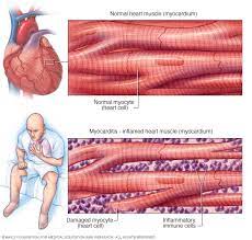 Myocarditis can cause blood flow to be reduced in certain parts of the body, may lead to blood clots developing in the heart, and can trigger a stroke or heart attack. Myocarditis Symptoms And Causes Mayo Clinic