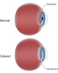 Cataract The Blinding Menace The Most Common Cause Of This Visual Handicap Is The Cataract It Leads To The Highest Number Cataract Surgery Cataract Eye Care