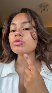 How to Cover A Chemical Burn