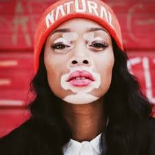 Black And White Skin Condition Model Pin By Oriana Cardarelli On Fashion Vitiligo Vitiligo Treatment Chantelle Brown Young