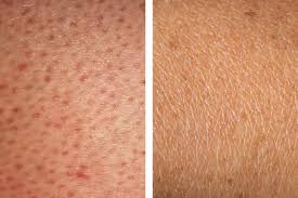 How To Get Rid Of Strawberry Legs 5 Treatments That Work In 2020 Strawberry Legs Ingrown Leg Hair Shaving Legs