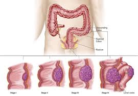 When observed under a microscope and tested in other ways, metastatic cancer cells have features like that of the primary cancer and not like the cells in the place where the metastatic cancer is found. Pin On Rectal Cancer