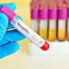Famous people with hemophilia hemophilia, also known as the royal disease, is a group of hereditary current estimates show that more than 20,000 individuals in the us are hemophilic. Https Encrypted Tbn0 Gstatic Com Images Q Tbn And9gcs9uqrwgvbiwhfybii9brq8v2yn6lfp4eb Yre 9b5vcxgjbcgq Usqp Cau
