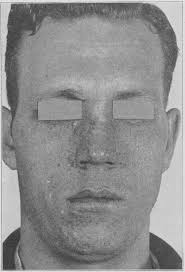 We are reporting a case of tuberous sclerosis sebaceum, epilepsy' and  mental deficiency, asso¬ ciated with tumor of the optic d