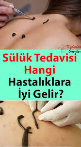 Suluk Tedavisi Hangi Hastaliklara Iyi Gelir Saglik Saglik Ve Fitness Saglik Urunleri