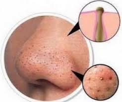 Clogged Pores On Nose Causes With White Stuff How To Clean Out Remedies Lightskincure