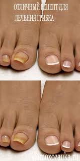 как избавиться от грибка в ухе в домашних условиях Otlichnyj Recept Dlya Lecheniya Gribka Lotion Bars Diy Face Products Skincare Skin Care Remedies