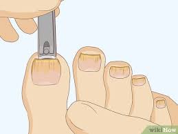 I do not drink ionic or colloidal silver, i use it for my fungal infection topically. How To Cure Toenail Fungus Can Vinegar Help