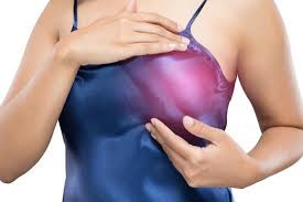 This type of breast cancer is called inflammatory because the breast often looks swollen and red, or inflamed, sometimes overnight. if you suspect that your breast rash is caused by inflammatory breast cancer, see a doctor for proper diagnosis and. Breast Rashes Breast Cancer Rashes Types