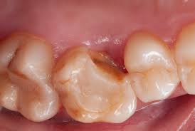 broken cusp molar diagram showing fracture and intact cusps