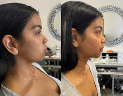 This girl came in for a half syringe then ended up coming back to add  another half! She has the most gorgeous natural lip shape and we just added  some luscious volume! #