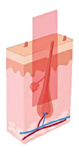 It had been performed experimentally for about twenty years before becoming commercially available in 1995 and 1996. Laser Hair Removal In Raleigh North Carolina Synergy Face Body