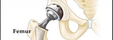 Aceasta articulatie este cea mai mare din corp, iar oasele care articulatia soldului este articulatia dintre bazin si femur, care leaga scheletul axial de extremitatea inferioara a corpului. Proteza De Sold Folosind Metoda Minim Invaziva