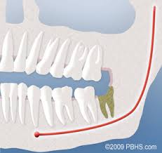Check spelling or type a new query. After Extraction Of Wisdom Teeth Richmond Va Dry Socket Infection Tuckahoe Bon Air Mechanicsville