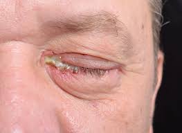 Image result for Conjunctivitis Resources