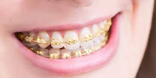 We perform all vital dental services such as teeth cleaning, braces, teeth whitening, fillings, crowns and bridges, as well as performing root canals. Gold Braces Houston Tx Dentist Dr Jasmine Explains The Role Of Gold In Orthodontics