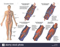 Deep Vein Thrombosis Dvt Female Stock Photo 7710040 Alamy