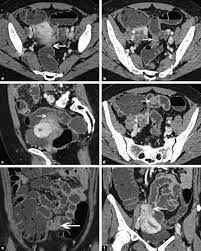 Doi although several radiological techniques have been used for the diagnosis of bowel endometriosis, no gold. Imaging Of Intestinal Involvement In Endometriosis Sciencedirect