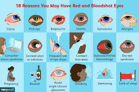 They can also be due to infections and allergic reactions. Red Eyes Reasons For Bloodshot Eyes