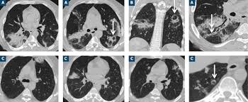 Previous history of smoking, infections, toxic exposure, immunodeficiency, chronic inflammatory disorders or transplantation must be known. Diagnostic Etiologique D Une Condensation Pulmonaire Chronique Apport De L Imagerie Sciencedirect