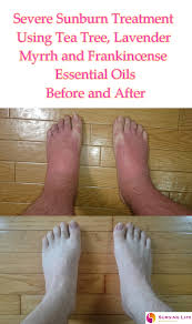 Use lotions that contain aloe vera to soothe and moisturize sunburnt skin. Essential Oils For Sunburn Treatment Mild To Severe Surginglife