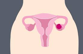 An ovarian cyst forms when fluid accumulates in a membrane of an ovary. When An Ovarian Cyst Ruptures Is It An Emergency Health Essentials From Cleveland Clinic