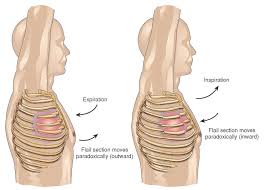 Image result for Flail Chest