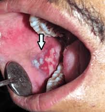 Image result for lichen planus on tongue)
