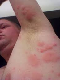 Find out when you need to see a dermatologist for medical treatment. Detergent Allergy Pictures Find Out If You Re Allergic To Laundry Detergent