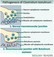 The most common way this happens is when a contaminated illicit drug, such as black tar heroin, is injected into muscle or skin. What Is Clostridium Botulinum Definition Morphology Exotoxin Biology Reader