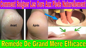 Comment Soigner Les Cors Aux Pieds Naturellement Remede De Grand Mere Youtube
