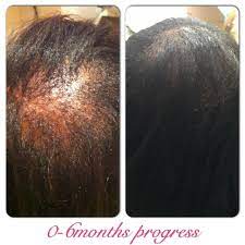 Let us look at 3 awesome emu oil recipes for hair growth and the best ways to use it. Jbco Emu Oil Scalp Pomade Fortheloveofkinks